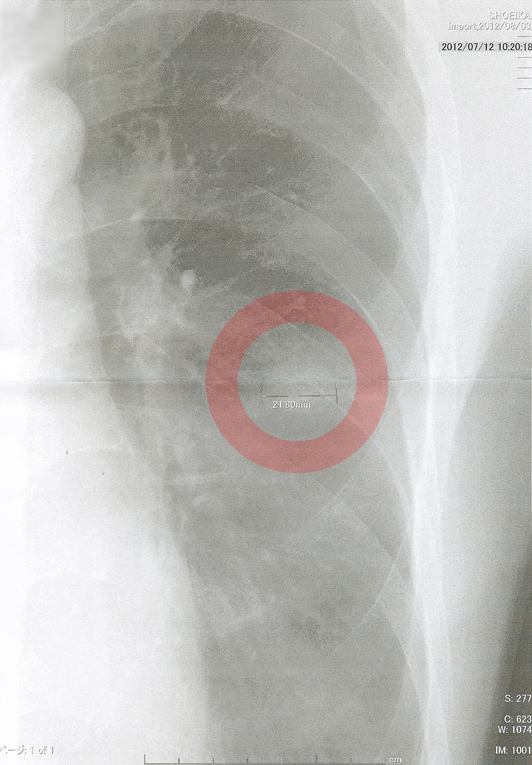2012年7月12日の胸部X線画像