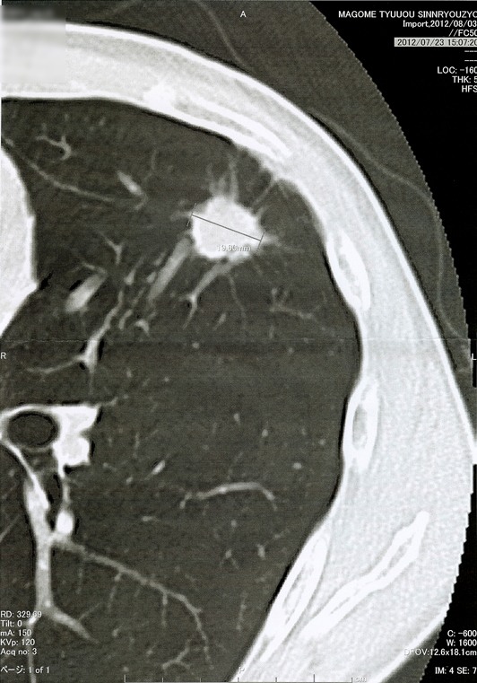2012年7月23日の胸部CT画像