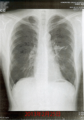2013年2月25日の胸部X線画像