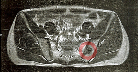 2013年12月25日に撮影した腰部MRI画像