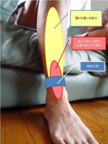 右足下腿伸筋支帯炎