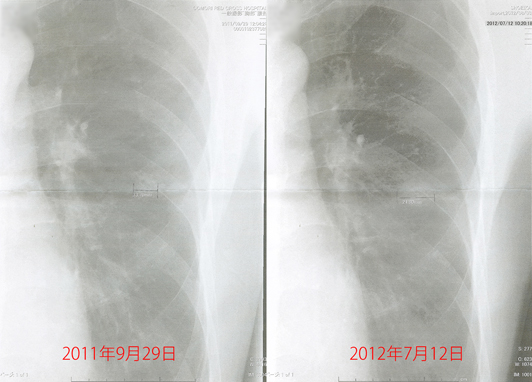 2011年9月29日の胸部X線画像