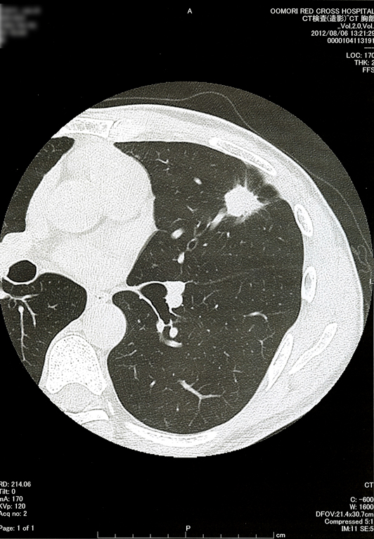 2012年8月6日の胸部CT画像