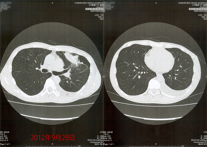 2012年9月28日の胸部CT画像