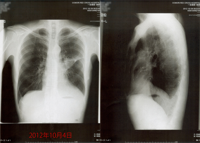 2012年10月4日の胸部X線画像