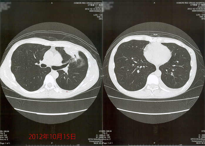 2012年10月15日の胸部CT画像