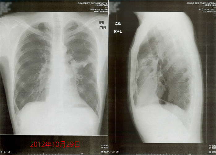 2012年10月29日の胸部X線画像
