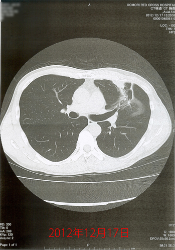 2012年12月17日の胸部CT画像