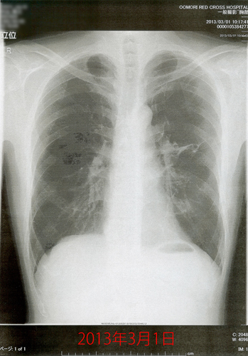 2013年3月1日の胸部X線画像