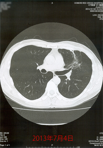 2013年7月4日の胸部CT画像