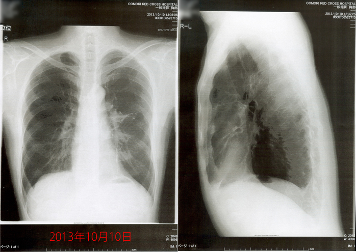 2013年10月10日の胸部X線画像