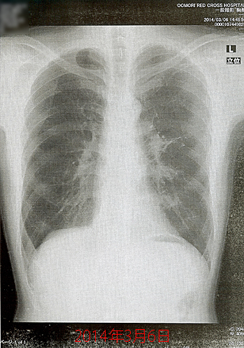 2014年3月6日の胸部X線画像
