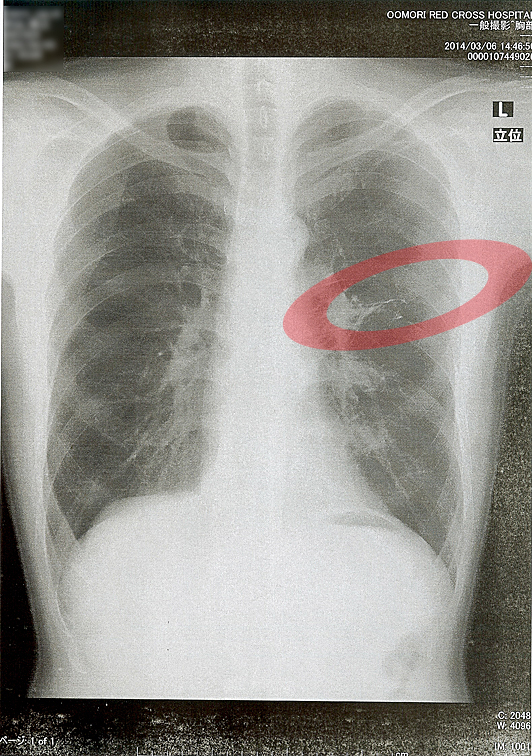 2014年3月6日の胸部X線画像
