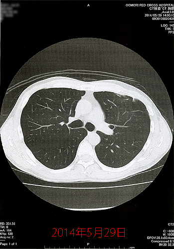 2014年5月29日の胸部CT画像