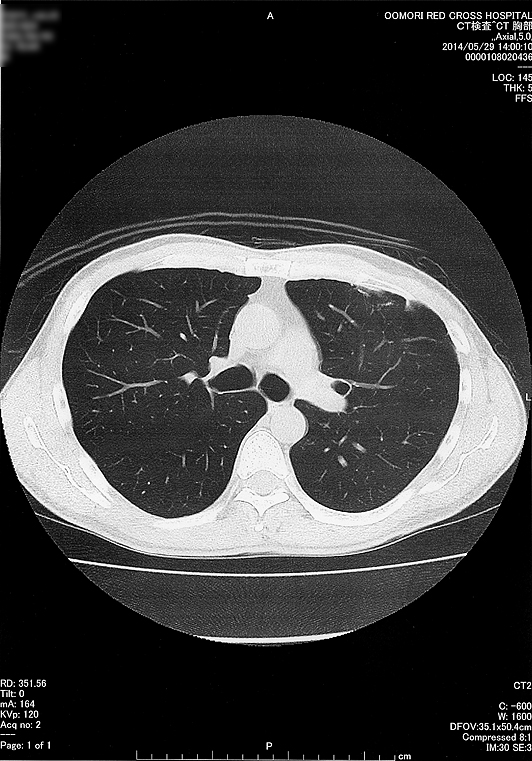 2014年5月29日の胸部CT画像