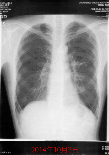 2014年10月2日の胸部X線画像