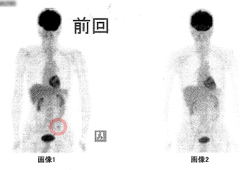 2014年12月3日のPET画像（昨年のPETとの比較）