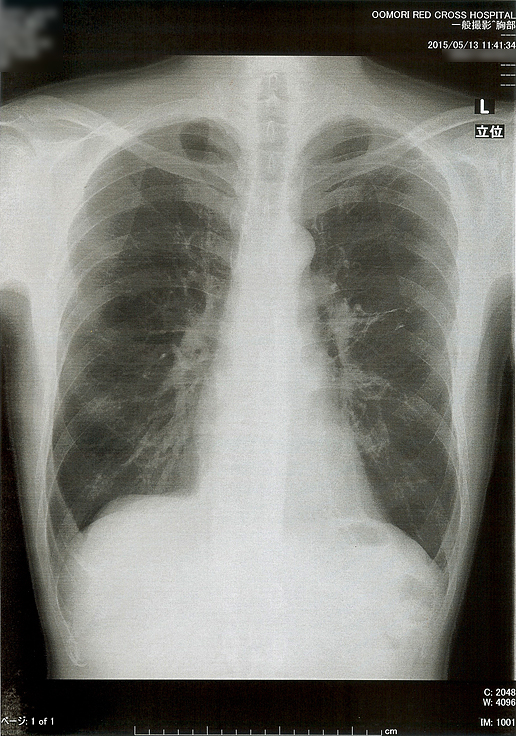 2015年5月13日の胸部X線画像