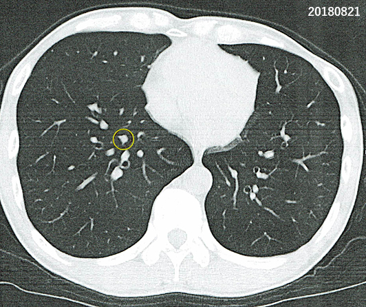 2018年8月1日に大分大学医学部附属病院で撮影した胸部CT画像