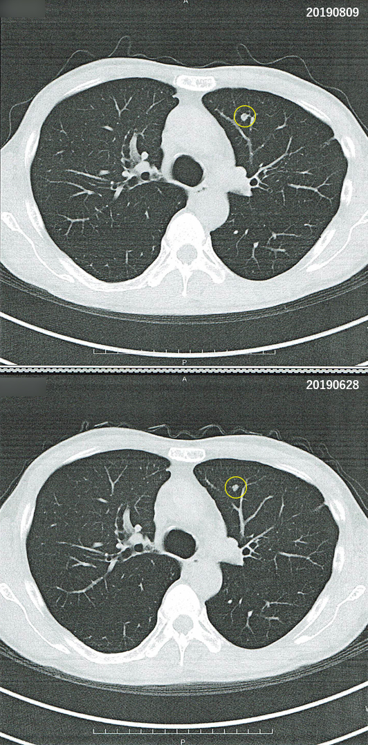 2019年6月28日の胸部CT画像と2019年8月9日の胸部CT画像との比較