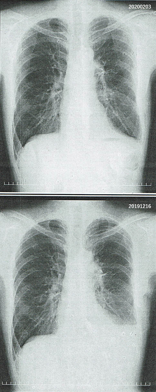 2019年12月16日の胸部X線画像と2020年2月3日の胸部X線画像との比較
