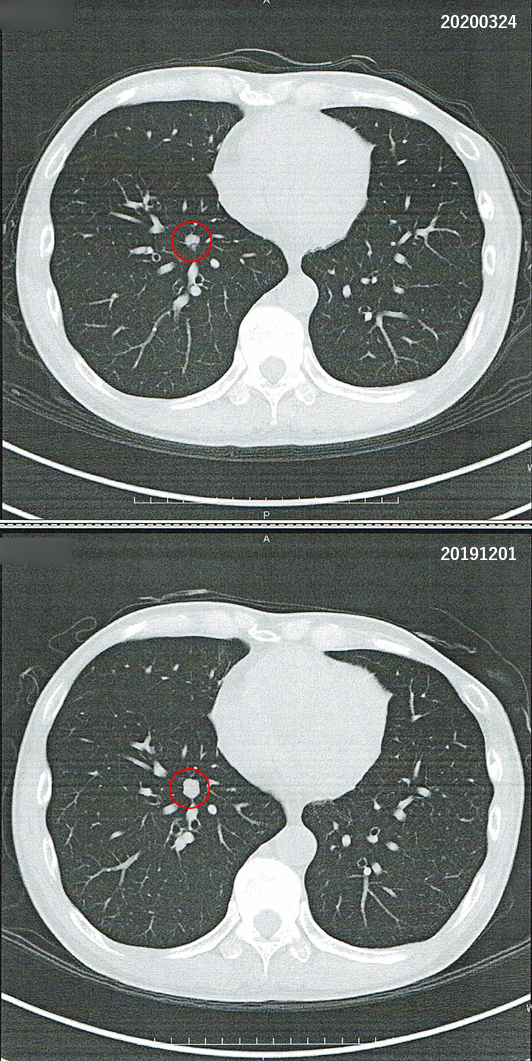 2019年12月1日の胸部CT画像と2020年3月24日の胸部CT画像との比較
