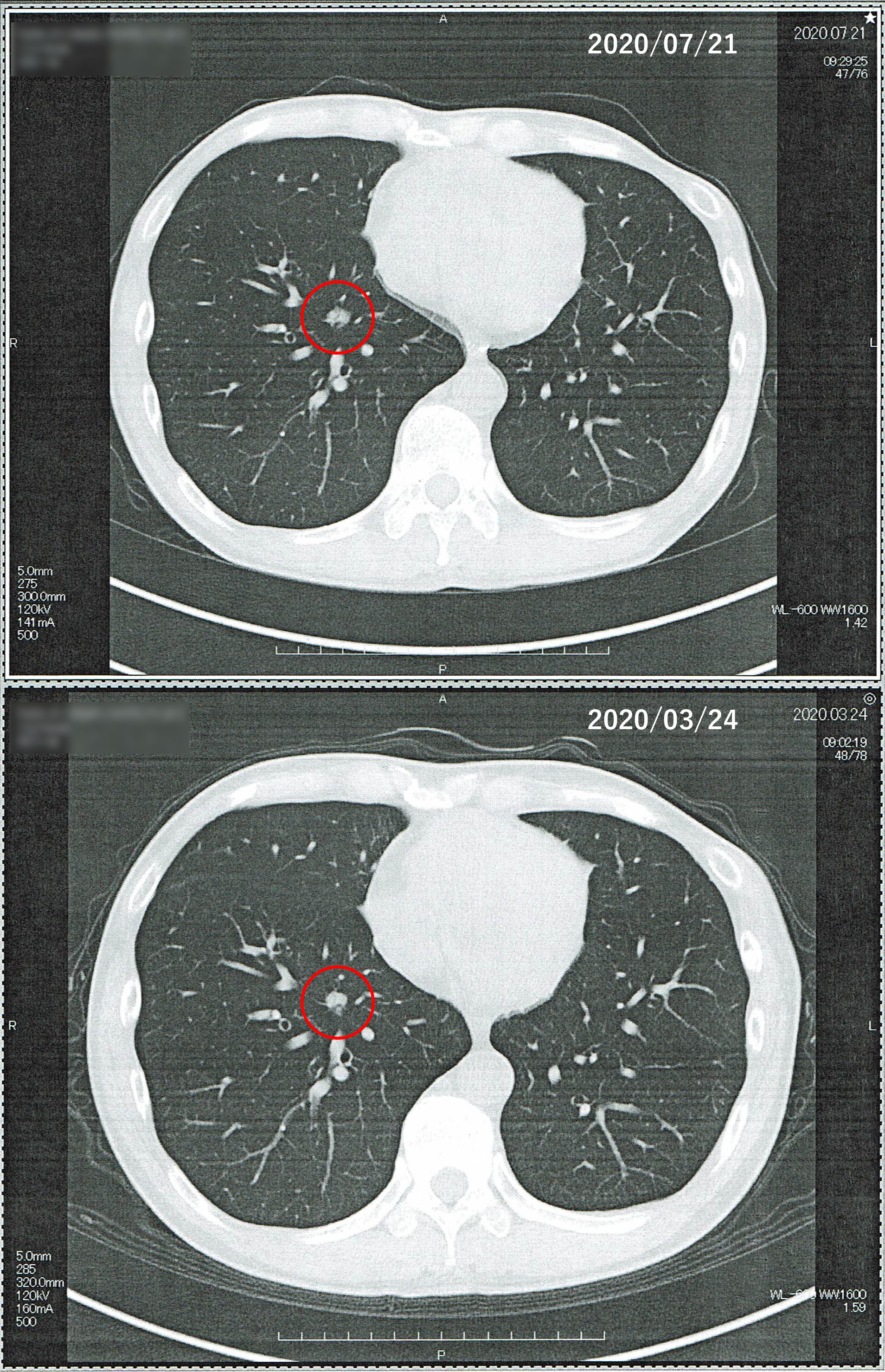 2020年3月24日の胸部CT画像と2020年7月21日の胸部CT画像の比較