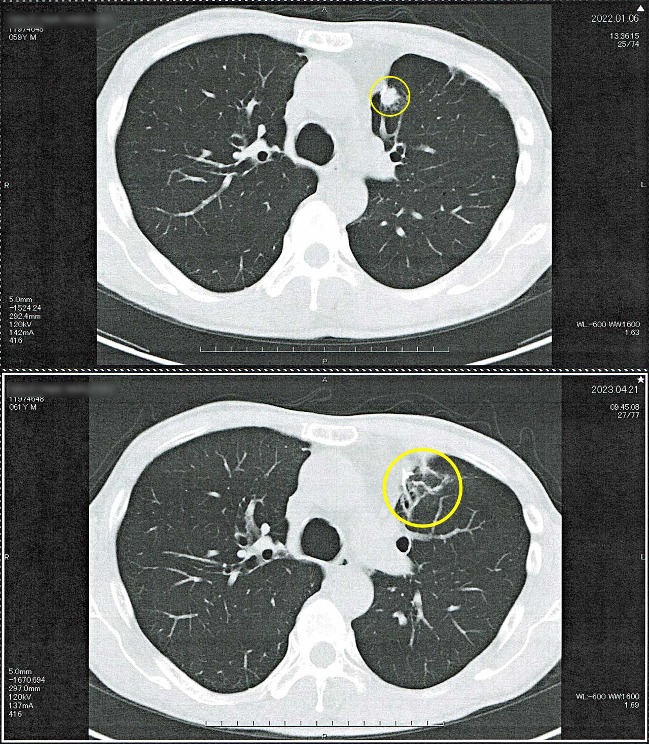 胸部CT 左肺サイバーナイフ施術痕