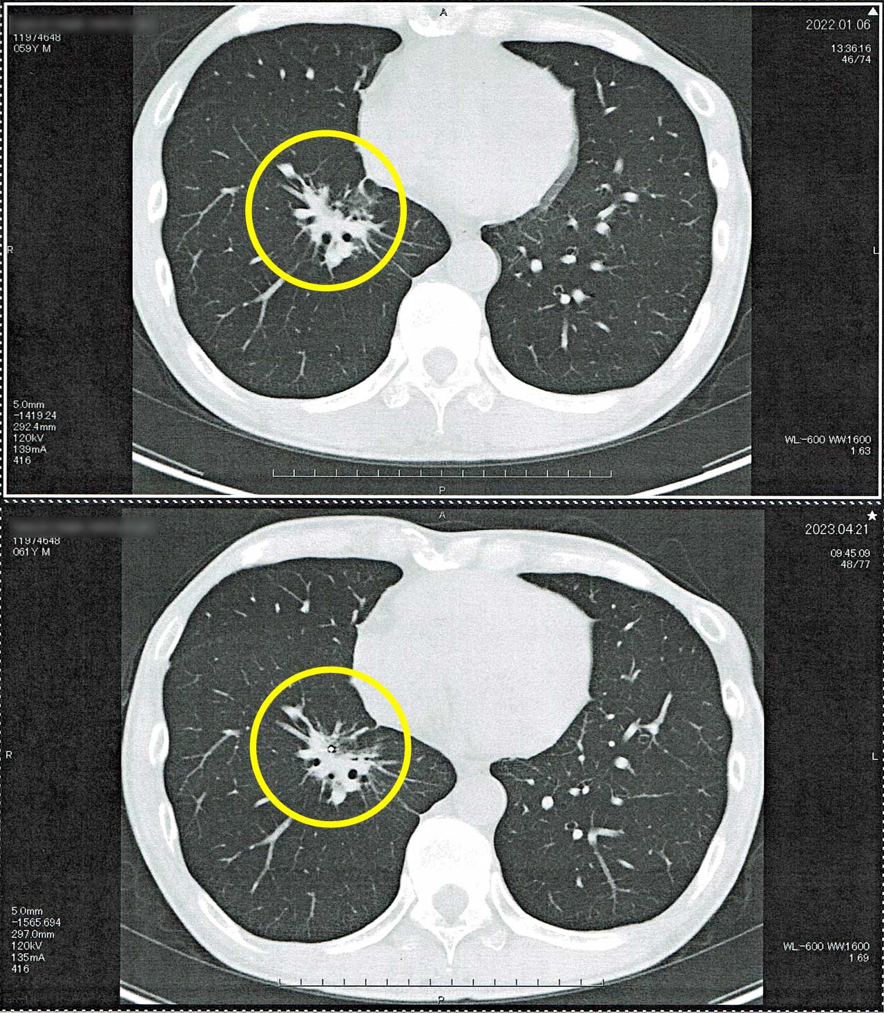 胸部CT 右肺サイバーナイフ施術痕
