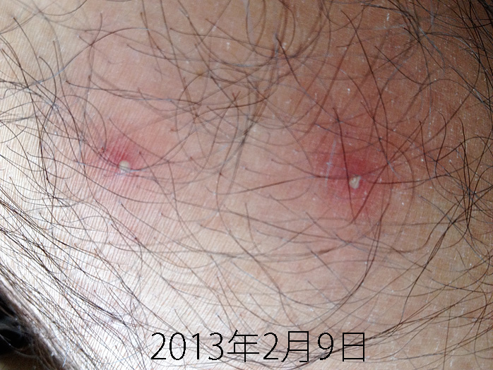 イレッサの副作用 手足のにきび 2013年2月9日