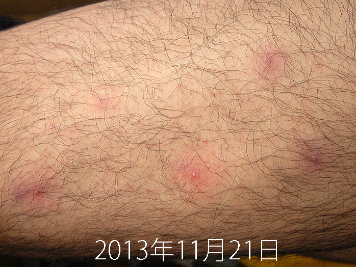 イレッサの副作用 手足のにきび 2013年11月21日