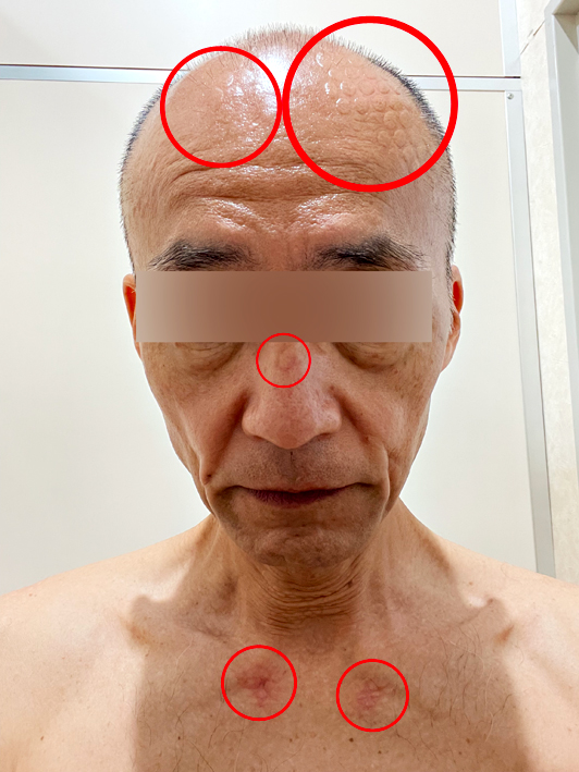 サイバーナイフの施術後の痕