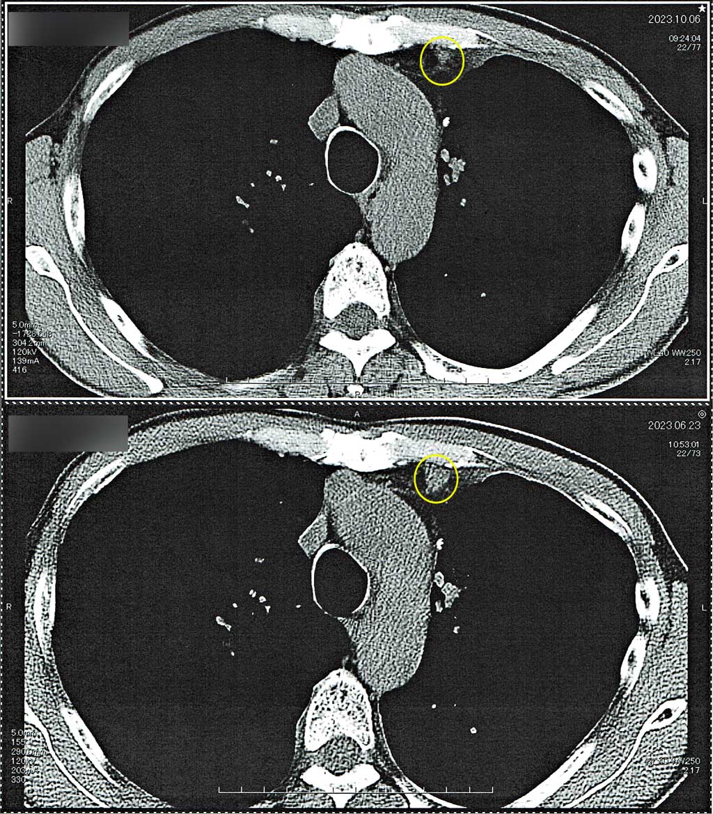 胸部CT（2023/10/06）
