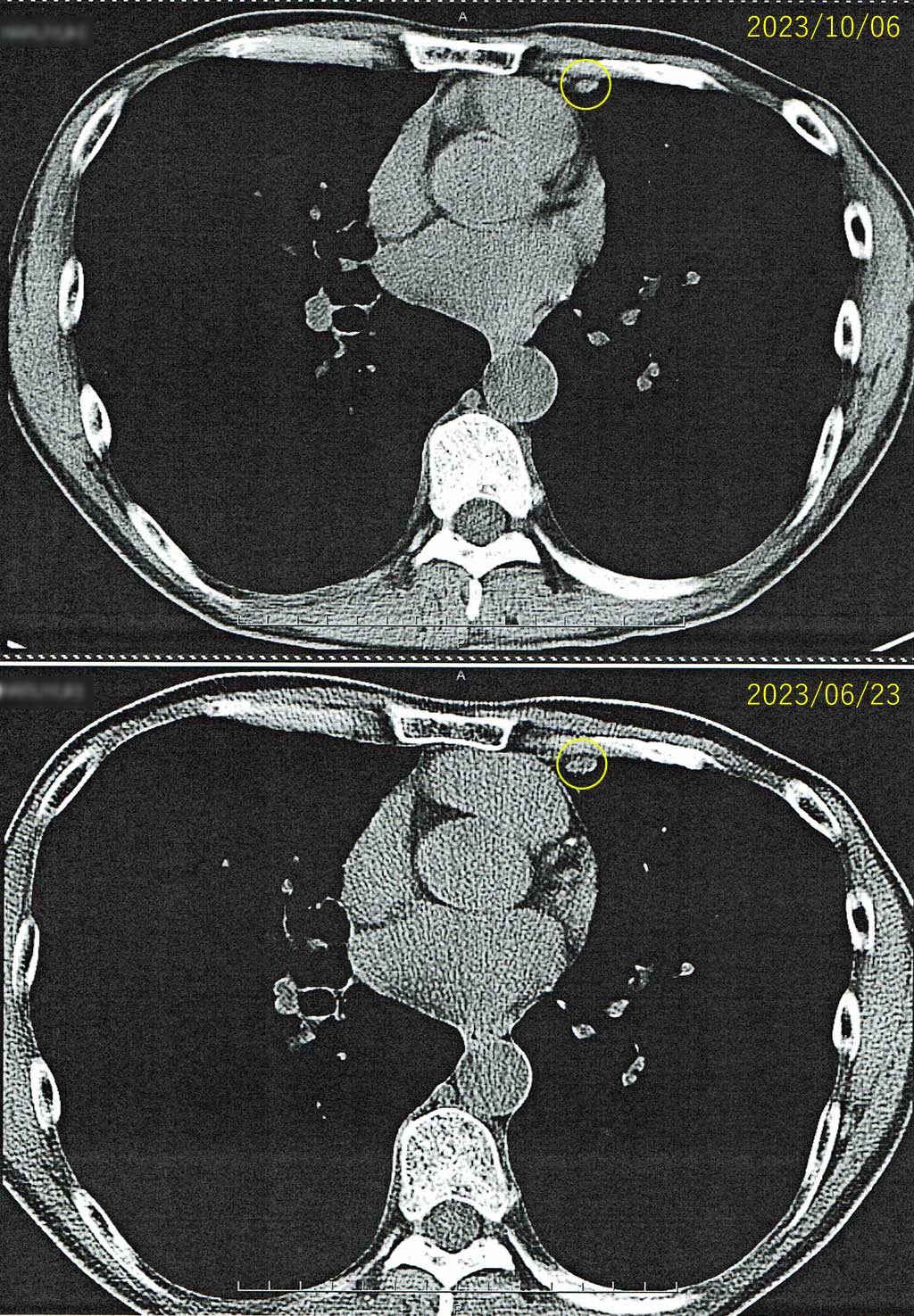 抗がん剤の投与の結果（左肺胸膜）