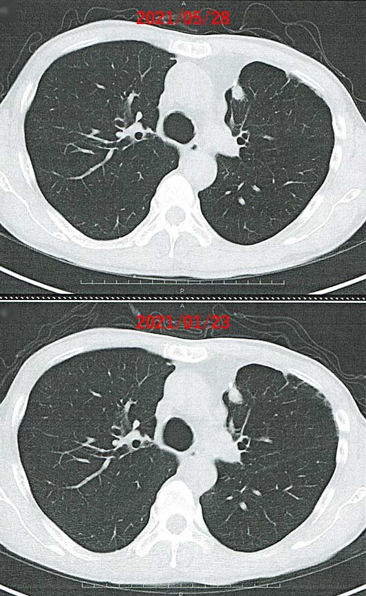 左肺の腫瘍の変化