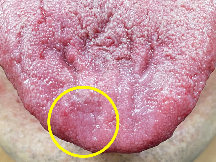 舌の上の発疹