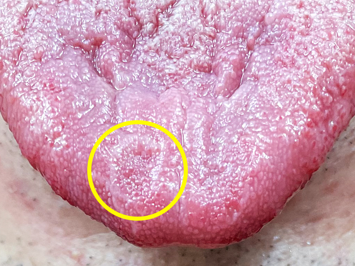 舌の上の発疹