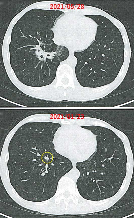 右肺の腫瘍の変化