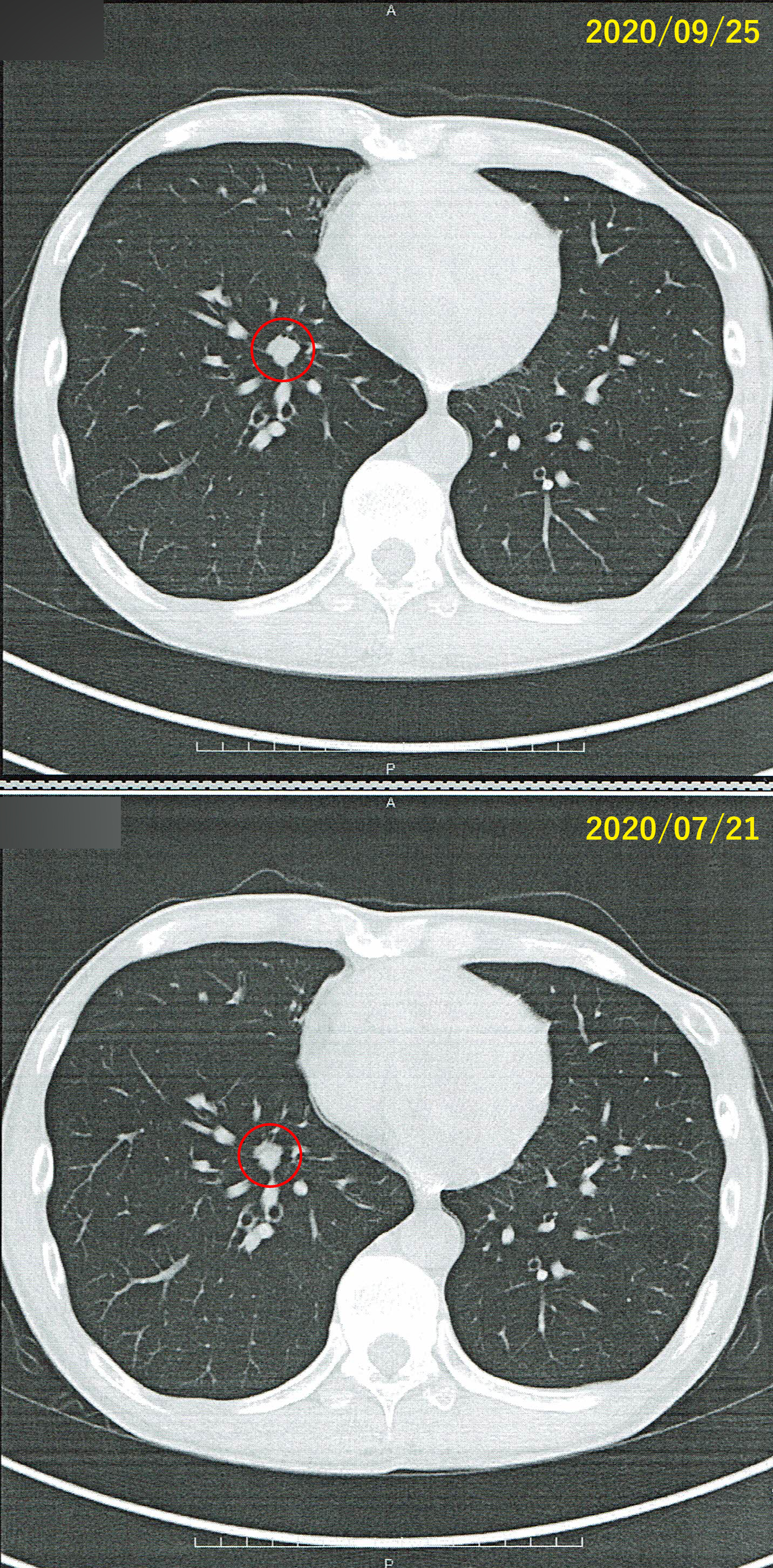 右肺の腫瘍の前回のCTと今回のCTの比較