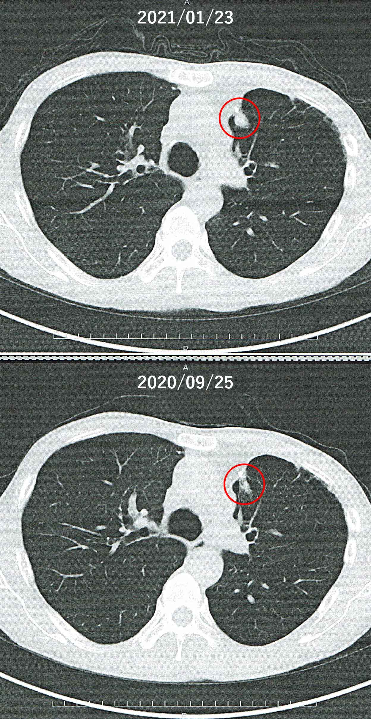 左肺に再発した癌