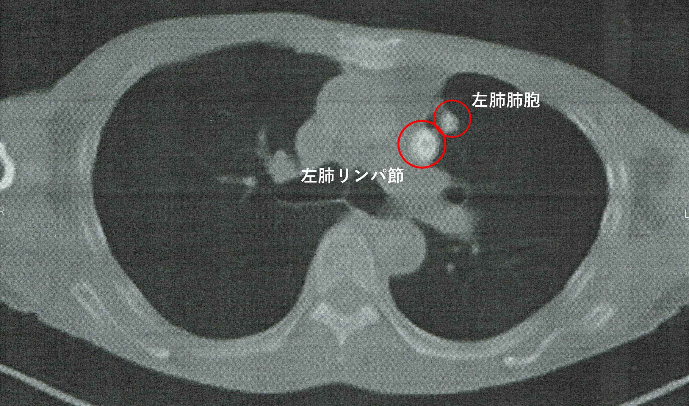 PETで光った左肺の肺胞とリンパ節