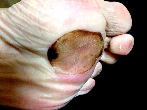 つくばマラソンで左前足部にできた巨大まめ