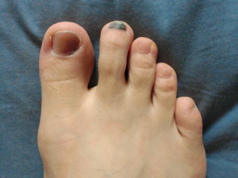 これがその結果(笑) 人差し指は骨折したのを知らずに骨がくっついた為､鍵の手のようになっています｡ これも足が抜けずに指先でつのめってしまう原因らしい･･･(汚い写真でスイマセン)