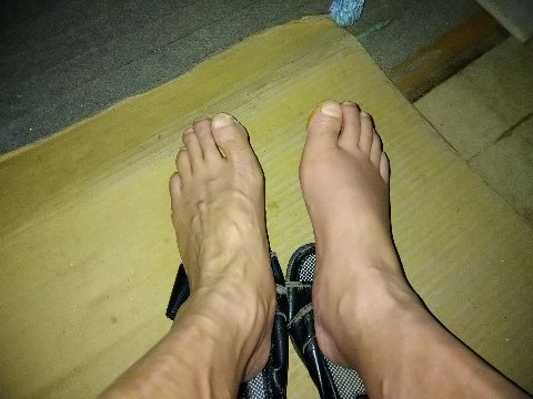 昨日より腫れはなくなってきてるが、血管や筋がみえない。圧迫されると痛いので今日はノーソックスにノーシューズ。