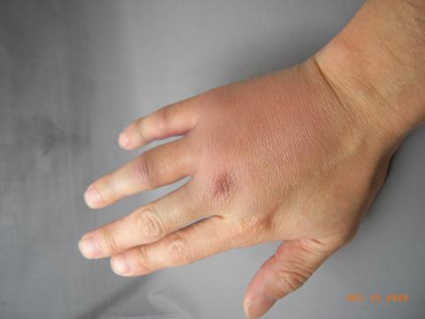 手の甲がまだ大きく腫れており、アイシングを続行中。