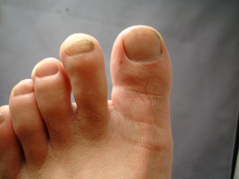 親指の付け根の薬指側が膨らんでいます。手で触るとなにやら脂肪の塊のようです。痛くはありません。