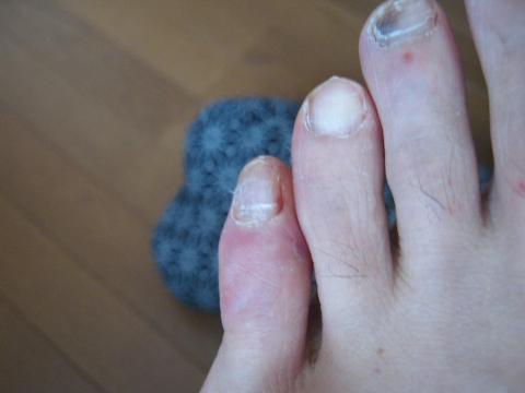 今朝の左足の小指　まだ結構腫れている。
レース終了後は痛みがひどく満足に歩けなかった